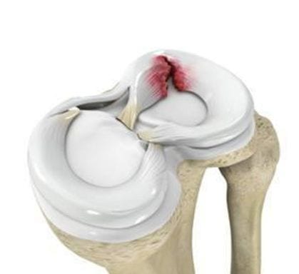 meniscus 